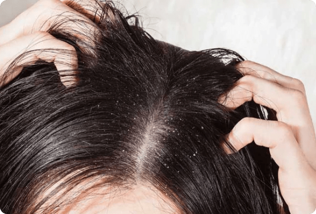 Close-up of a scalp with visible dandruff and fingers running through dark hair.