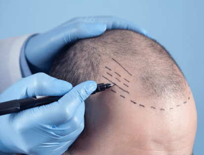 The image shows a person in blue gloves marking a bald head with a pen, preparing for a hair transplant surgery.