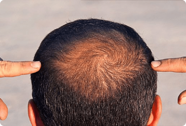 The image shows a person with hair fall problem, revealing a bald spot. Fingers are pointing towards the bald spot. Person is suffering from Hair loss issues.