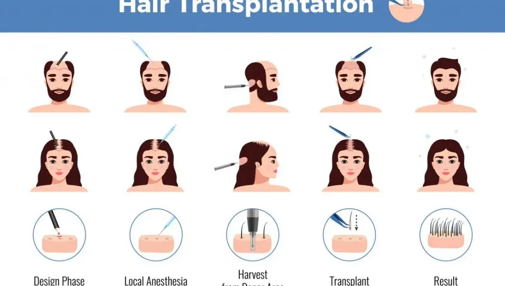 “A step-by-step illustration of the hair transplantation process including the design phase, local anesthesia application, harvesting from the donor area, transplanting, and showing the final result.