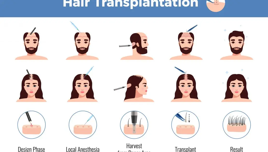 Steps you must follow Before and after Hair Transplant | Instructions