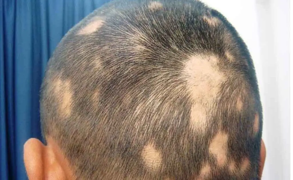 The image shows a person with hair loss problem, revealing a visible scalp pattern. Their remaining dark, short hair contrasts against a plain, blue colored background.