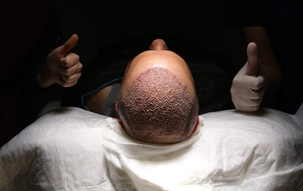 Is Hair transplant Painful? All you need to know.