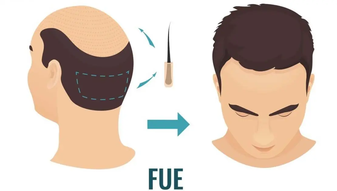 Top 5 Benefits of FUE hair restoration method