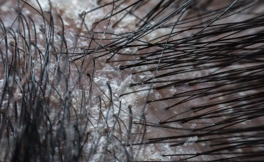 A close-up image showing black hair strands and a scalp with visible dandruff flakes.