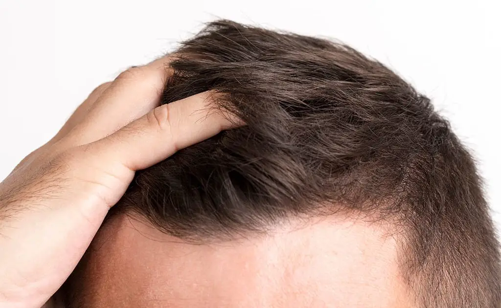A closeup look on person's scalp showing the signs of hair loss with receding hairline.