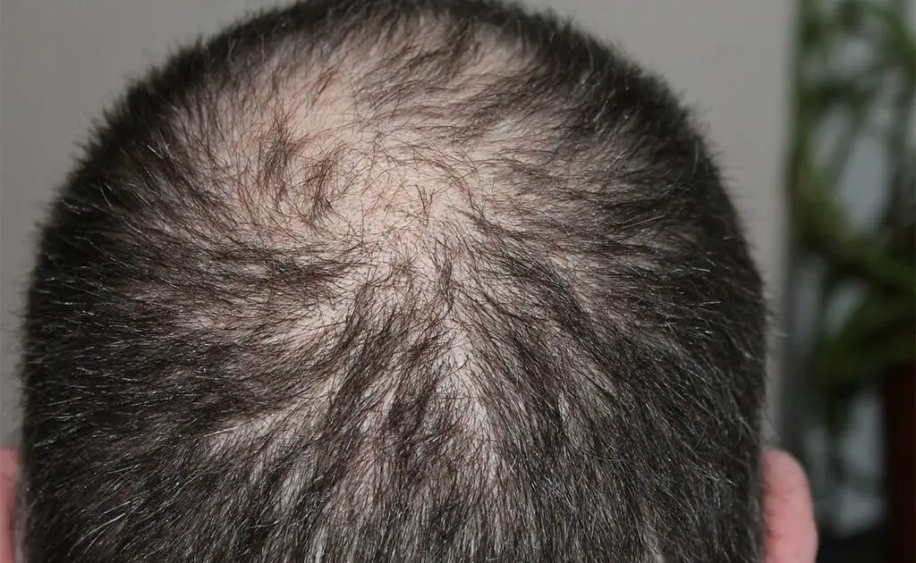 The image shows a person with hair fall problem, revealing a bald spot. Their remaining dark, short hair contrasts against a plain, light-colored background. Person is suffering from Hair thinning Problem.