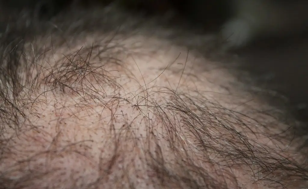 Close-up image of human skin with scattered hair growth, showing detail of hair texture and skin surface. The person is facing male pattern baldness.