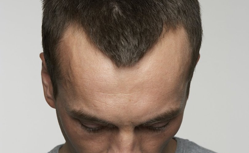 Prevent & Regrowth Receding Hairline with Hair Transplant