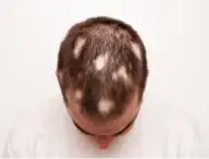 The image shows a person with hair loss problem, revealing a visible scalp pattern. Their remaining dark, short hair contrasts against a plain, light-colored background.