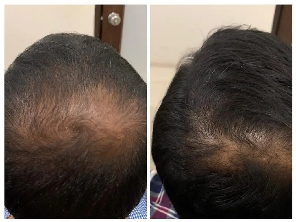 Before and after image of a person’s scalp, showcasing the results of hair transplant. The left image shows thinning hair with marked areas for treatment, while the right image displays fuller hair growth post-treatment.