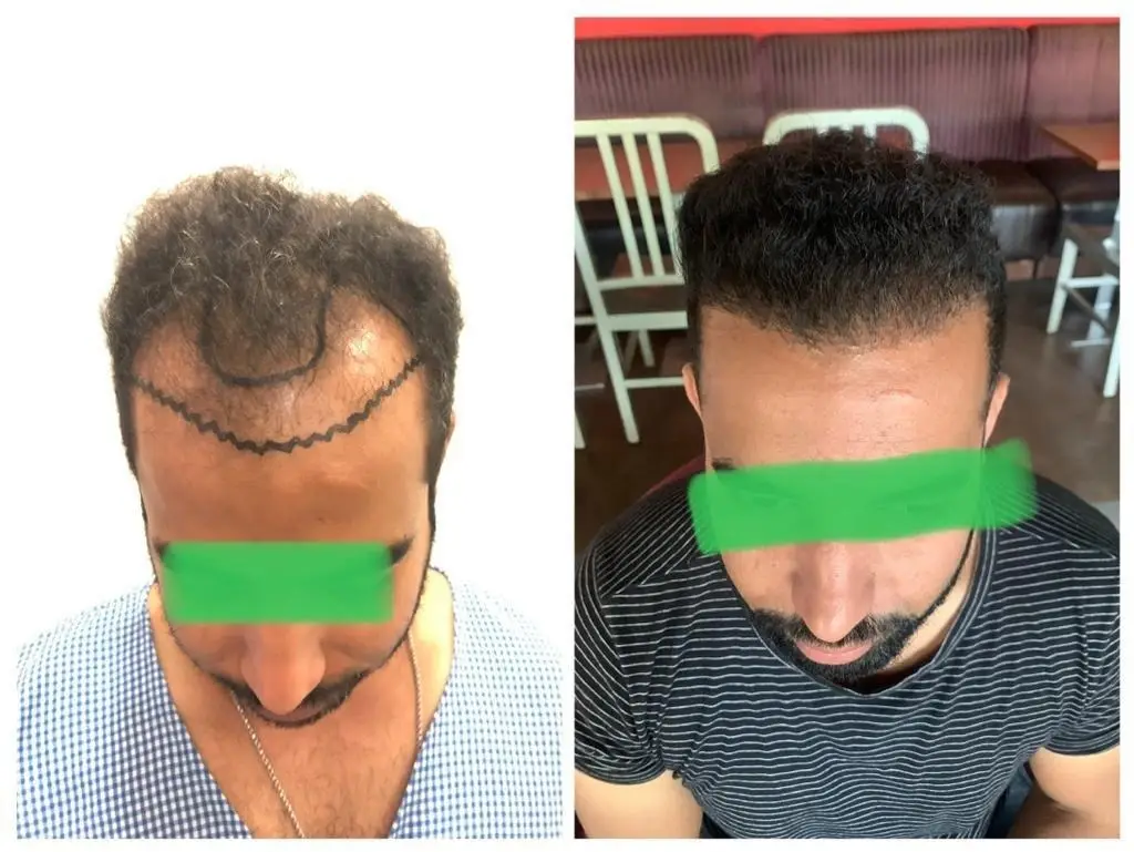Before and after image of a person’s scalp, showcasing the results of hair transplant. The left image shows thinning hair with marked areas for treatment, while the right image displays fuller hair growth post-treatment.