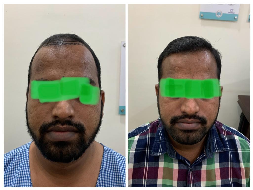 Before and after image of a person, showcasing the results of hair transplant. The left image shows thinning hair with marked areas for treatment, while the right image displays fuller hair growth post-treatment.