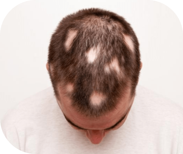 The image shows a person with hair loss problem, revealing a visible scalp pattern. Their remaining dark, short hair contrasts against a plain, light-colored background.