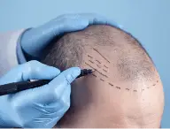 The image shows a person in blue gloves marking a bald head with a pen, preparing for a hair transplant surgery.