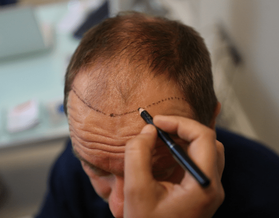 The image shows a person marking a bald head with a pen, preparing for a hair transplant surgery.