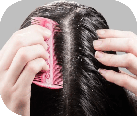 A person using a pink comb to part and style dark, shiny hair. The hair in the image appears to have dandruff and scalp problems.