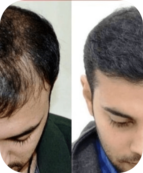 A before and after photo of a person where he is dealing with baldness in left photo and with hair regrowth in right photo after transplantation.