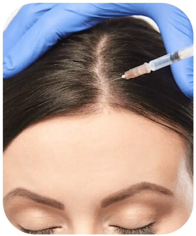 A person receiving PRP hair treatment with a syringe applied to the scalp by a professional wearing blue gloves.
