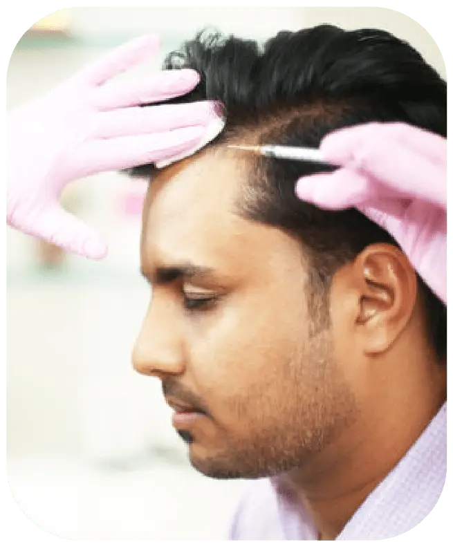 A person receiving GFC hair treatment with a syringe applied to the scalp by a professional wearing pink gloves.