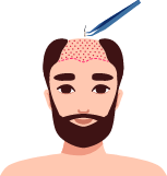 Illustrations depicting the hair transplantation process which includes Hair grafts being implanted into the balding area on the scalp.