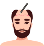 Illustrations depicting the hair transplantation process which includes Scalpel incision on a balding scalp.